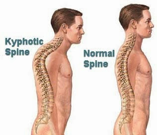 Pengobatan Sakit Punggung Atas